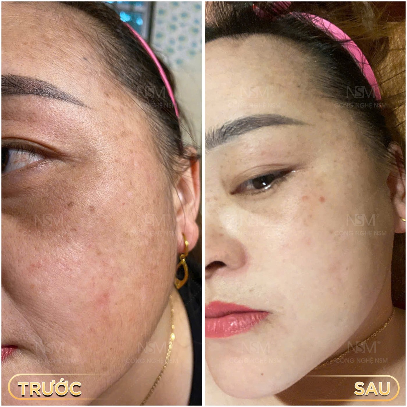Khách hàng trước và sau khi chăm sóc da tại NSM SKINLAB