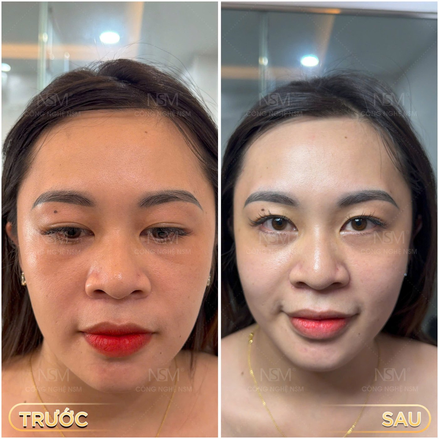 Khách hàng trước và sau khi chăm sóc da tại NSM SKINLAB