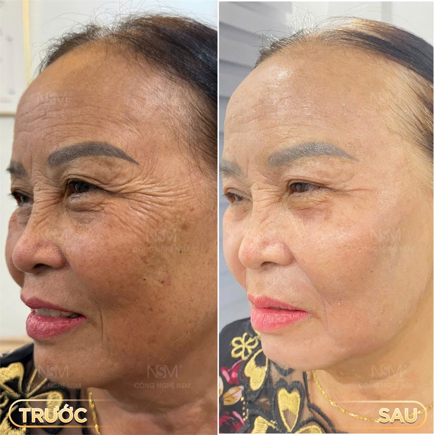 Khách hàng trước và sau khi chăm sóc da tại NSM SKINLAB