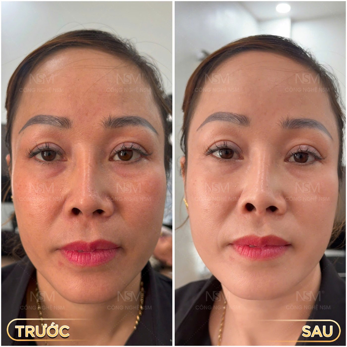 Khách hàng trước và sau khi chăm sóc da tại NSM SKINLAB
